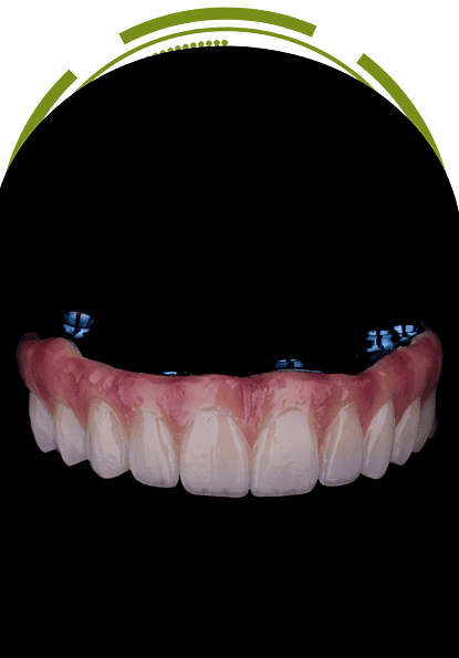 Full zirconia All-on-4 prosthesis with pink gum and natural-looking teeth – EnamelDent EnamelDent All on 4 Tijuana